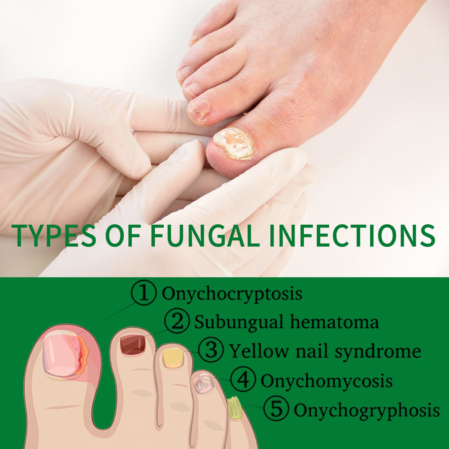 7 Days Nail Fungus Treatment